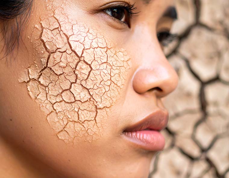 Winter Skin Woes? Omega-3 to the Rescue!